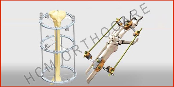 external-fixator